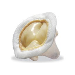Tissue valve used in heart surgery