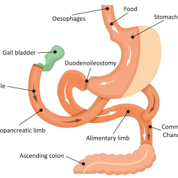 Illustration of the Laparoscopic BPD-DS procedure