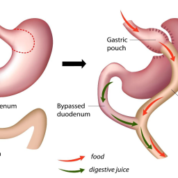 Illustration of the Laparoscopic RNY procedure