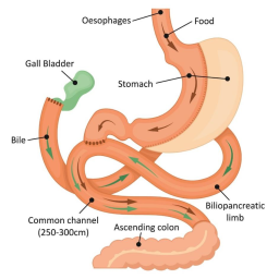 Illustration of the Laparoscopic SADI-S procedure