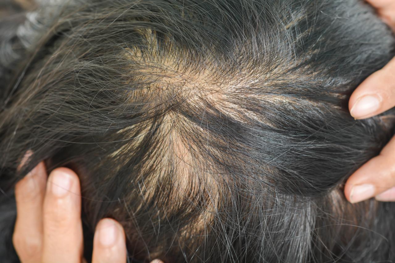 balding
