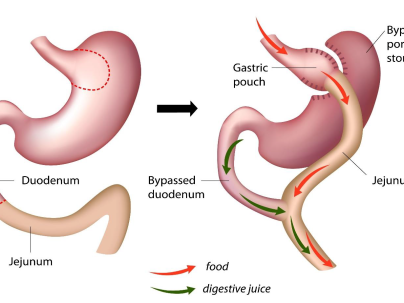 Illustration of the Laparoscopic RNY procedure
